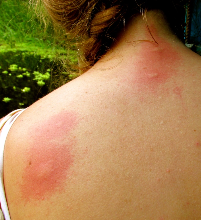 My back where the mosquitos managed to get under the life jacket - this is nothing compared to my legs!